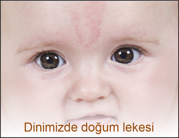 Dogum lekesini vucuttan gidermenin hukmu nedir